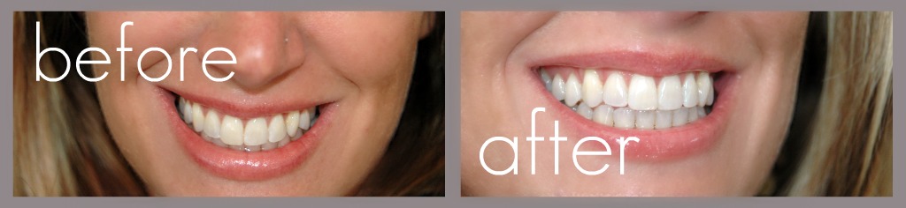 crest-3d-white-2-hour-express-whitestrips-before-and-after-and-coupon